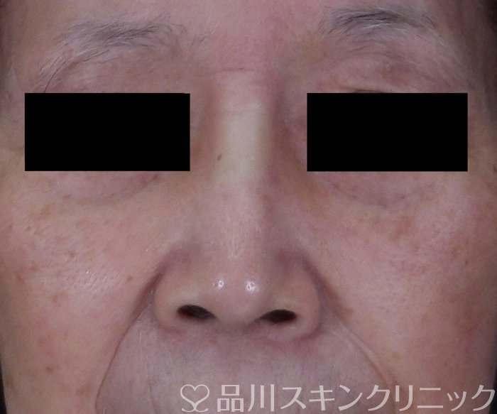症例NO.70392のAFTER写真