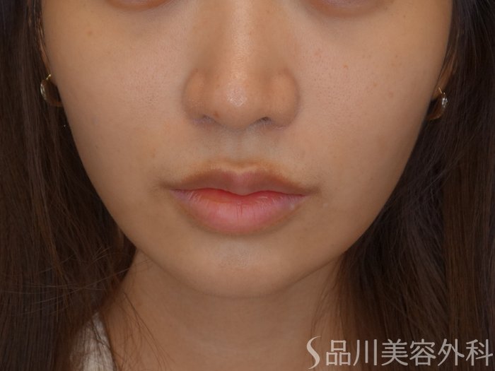 症例NO.74725のBEFORE写真