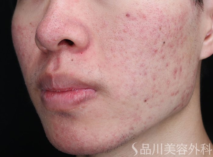 症例NO.73536のBEFORE写真