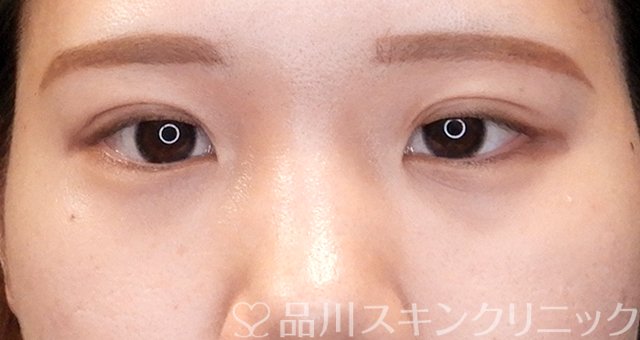 症例NO.66303のAFTER写真