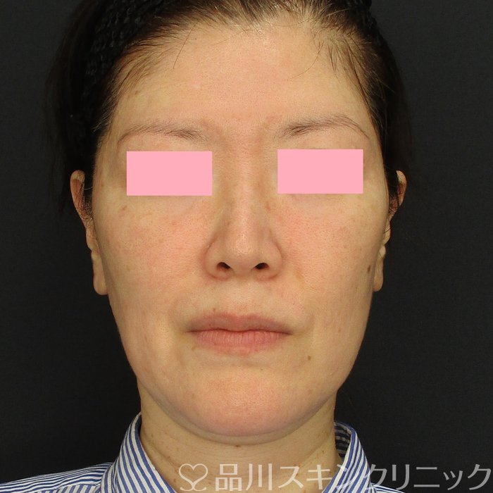 症例NO.74199のBEFORE写真