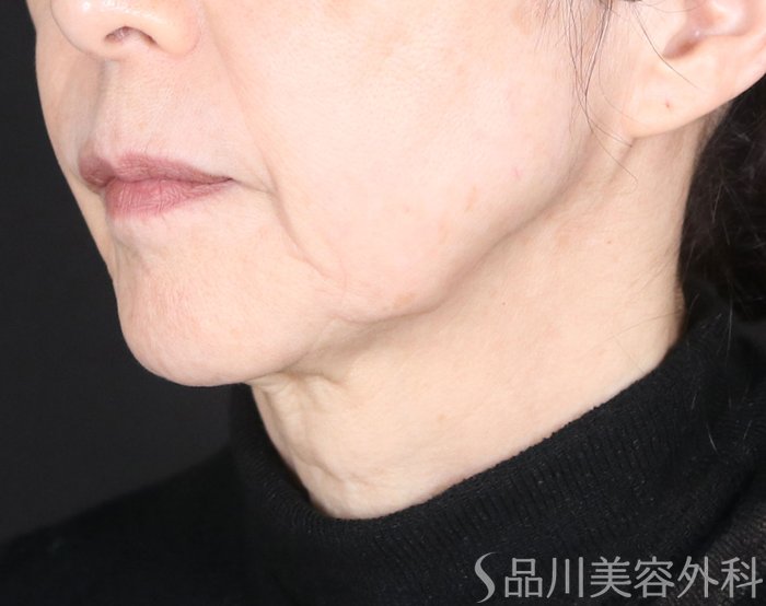 症例NO.72265のBEFORE写真