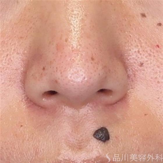 症例NO.55022のBEFORE写真