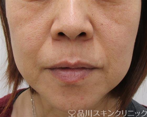 症例NO.41093のBEFORE写真