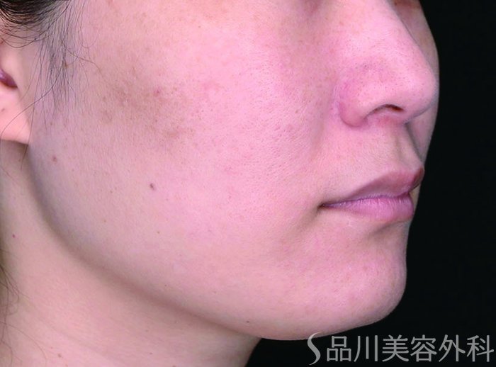 症例NO.74236のBEFORE写真