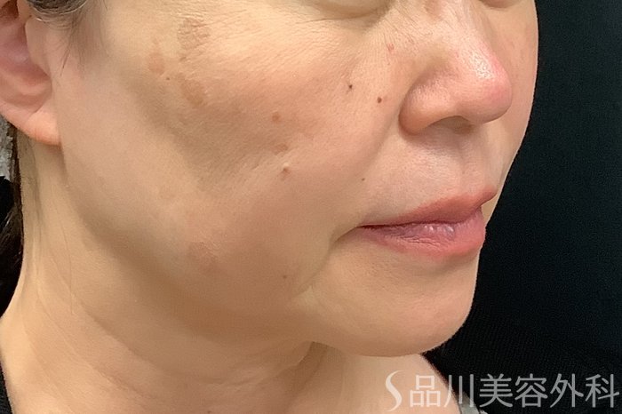 症例NO.73321のBEFORE写真