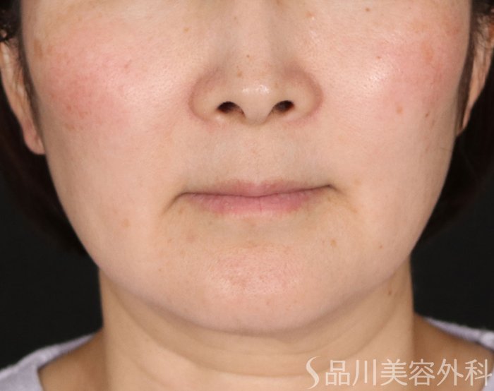 症例NO.72077のBEFORE写真