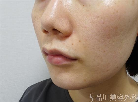 症例NO.51905のAFTER写真