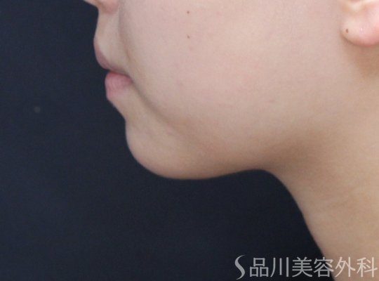症例NO.71149のAFTER写真
