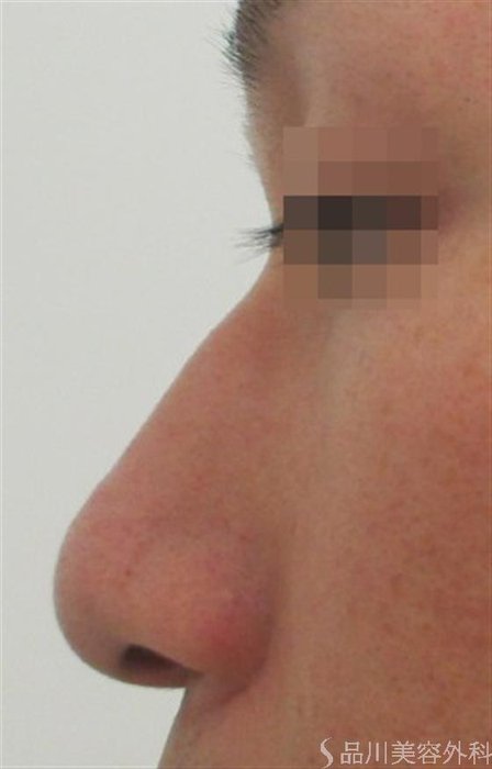 症例NO.22954のBEFORE写真