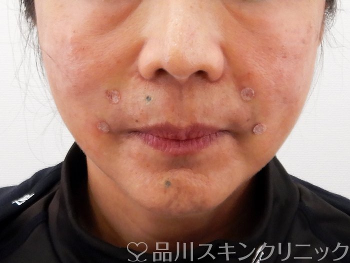 症例NO.62186のAFTER写真