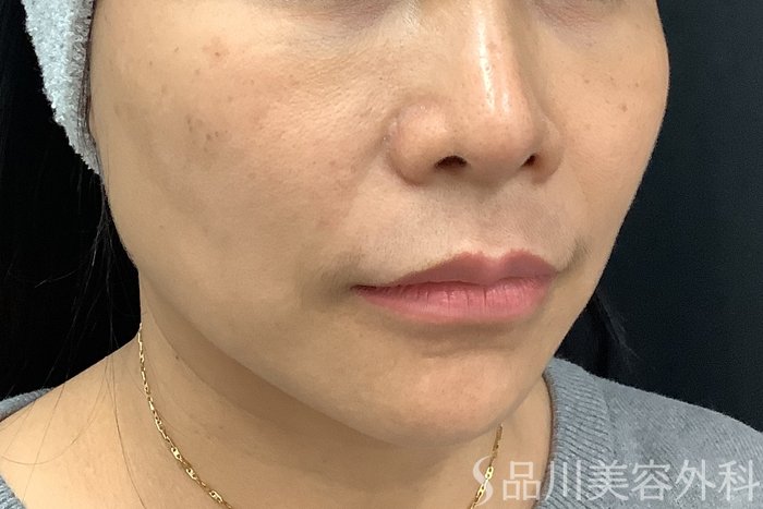 症例NO.73318のBEFORE写真