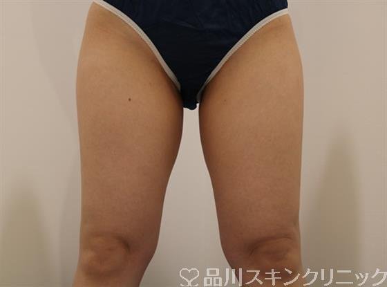 症例NO.42452のAFTER写真