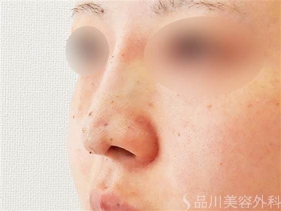 症例NO.56413のAFTER写真