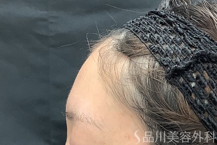 症例NO.71235のBEFORE写真