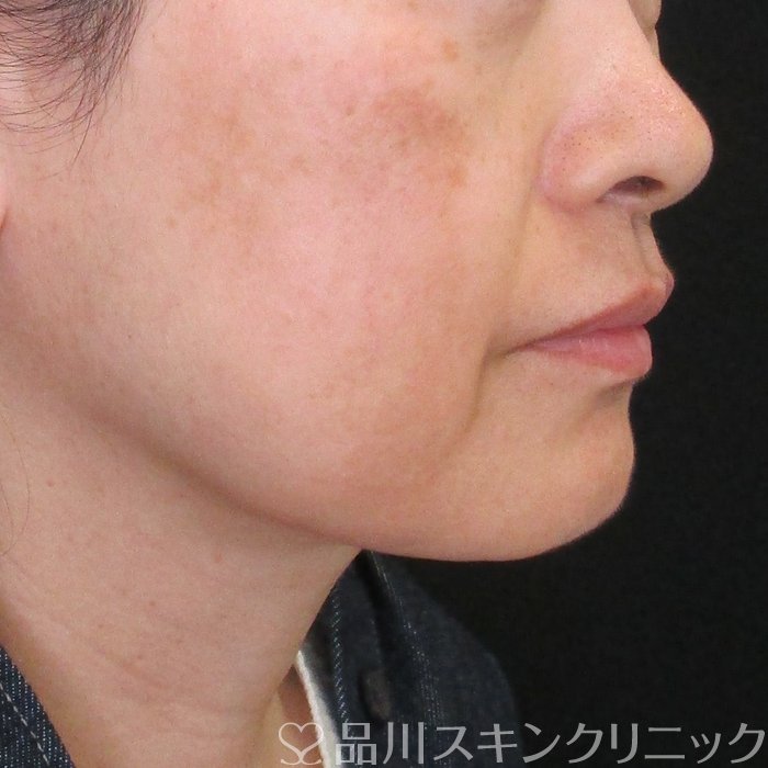 症例NO.75169のBEFORE写真