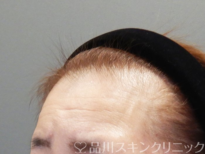 症例NO.73039のBEFORE写真