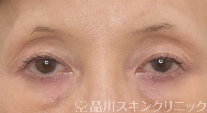 症例NO.69556のBEFORE写真