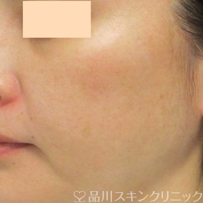 症例NO.69341のAFTER写真