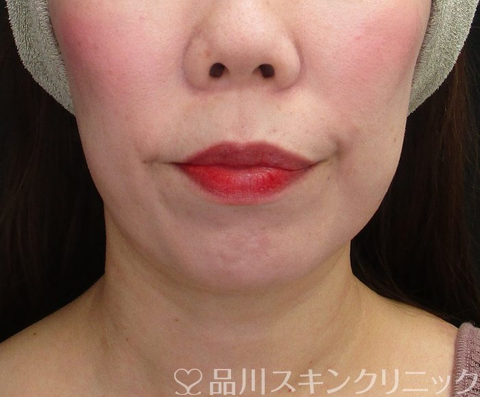 症例NO.73610のBEFORE写真