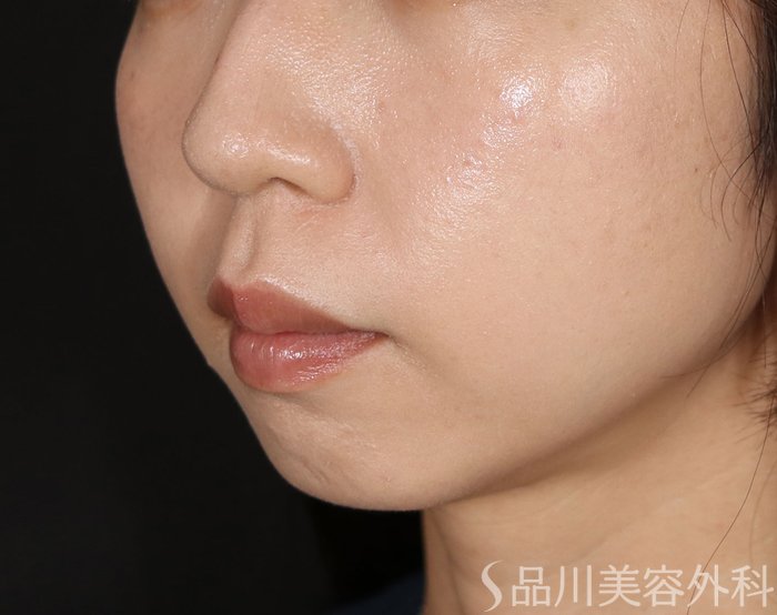 症例NO.71885のAFTER写真