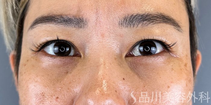 症例NO.65553のAFTER写真