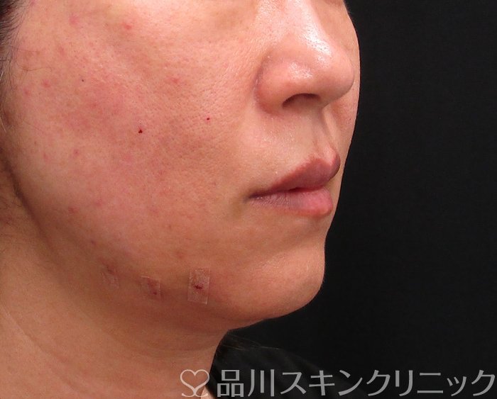 症例NO.73595のAFTER写真