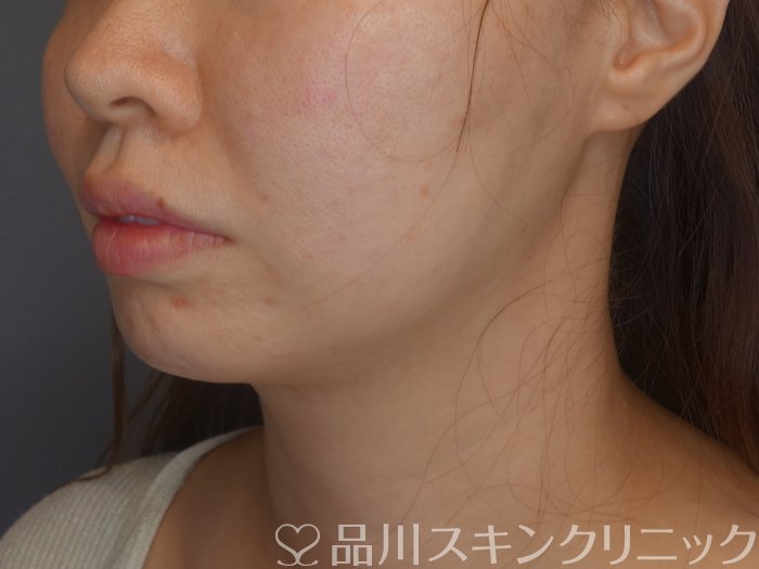 症例NO.71881のAFTER写真