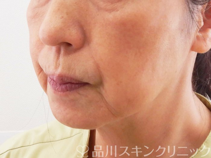症例NO.62187のBEFORE写真