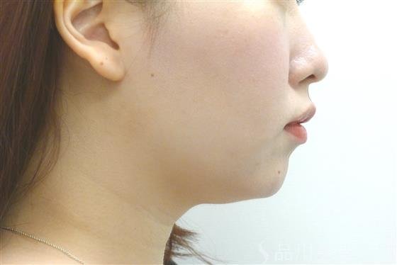 症例NO.39903のBEFORE写真