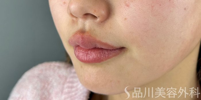 症例NO.70179のAFTER写真