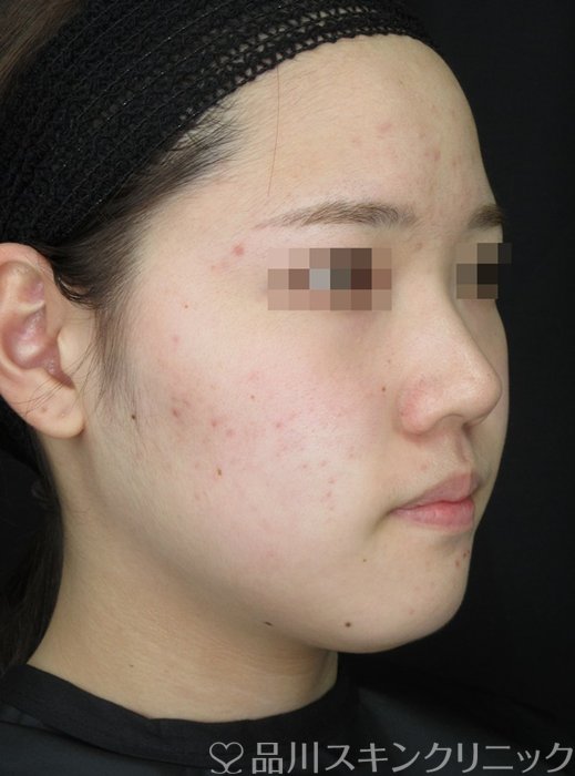 症例NO.72137のBEFORE写真