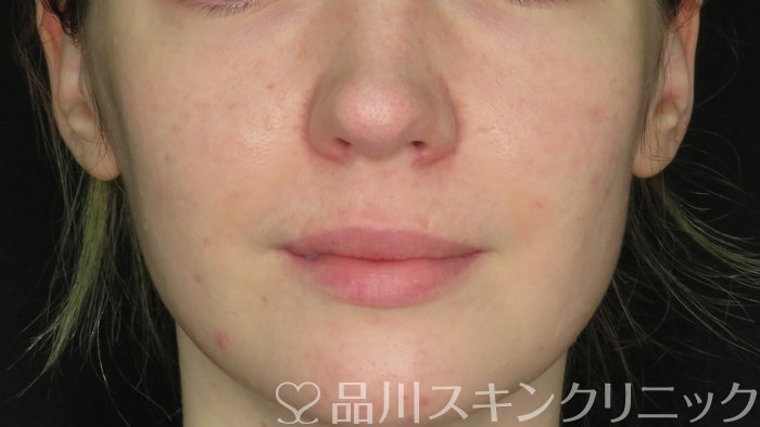 症例NO.71268のBEFORE写真