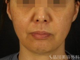 症例NO.70996のBEFORE写真