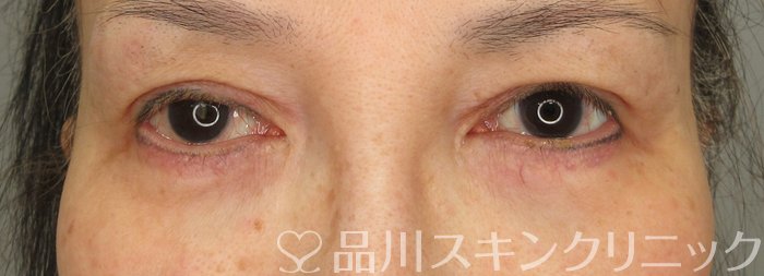 症例NO.74062のAFTER写真