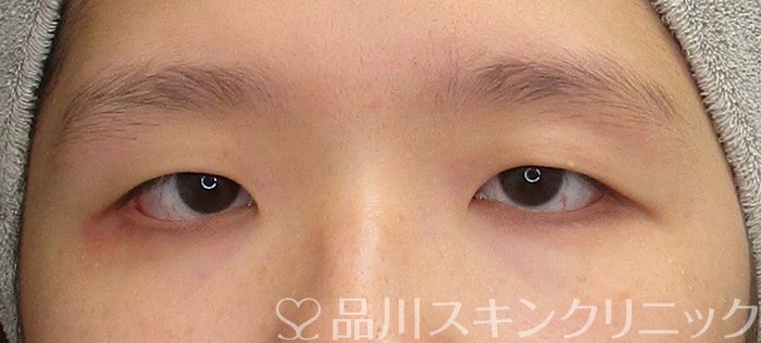 症例NO.72670のBEFORE写真