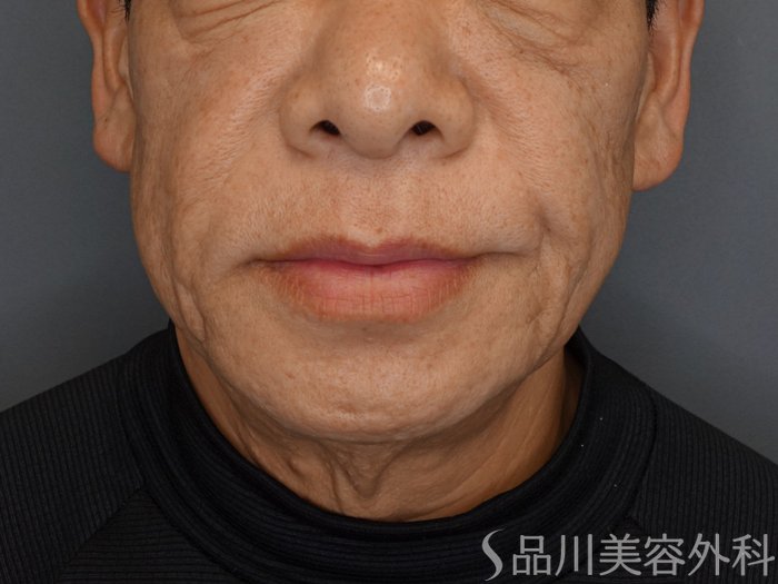 症例NO.74799のBEFORE写真