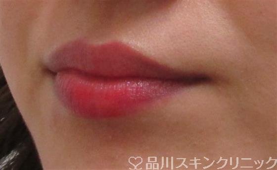 症例NO.31539のBEFORE写真