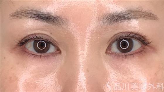 症例NO.54370のAFTER写真