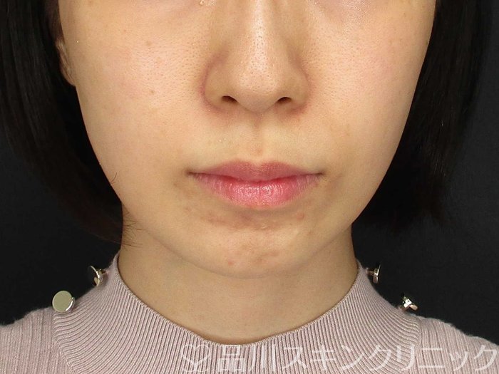 症例NO.68420のAFTER写真