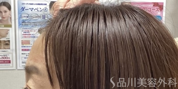 症例NO.68290のAFTER写真