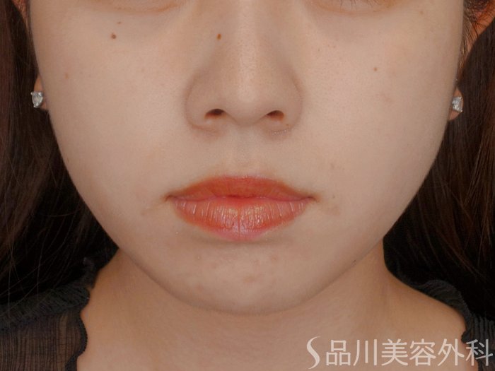 症例NO.73772のBEFORE写真