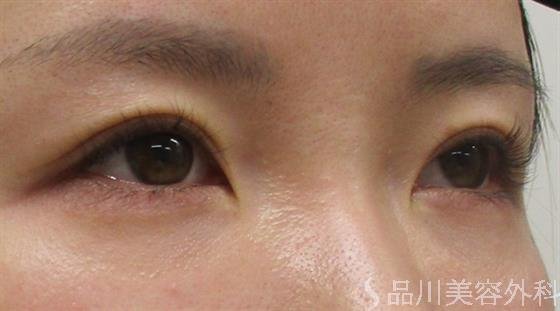 症例NO.54757のBEFORE写真
