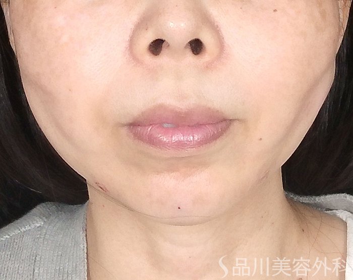 症例NO.64809のAFTER写真