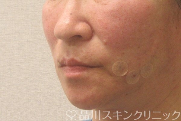 症例NO.75165のAFTER写真