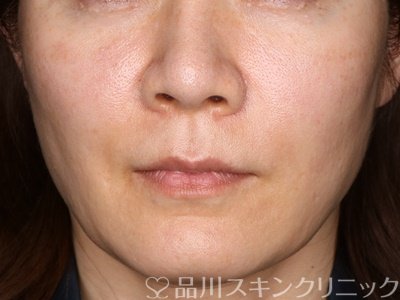 症例NO.73915のAFTER写真