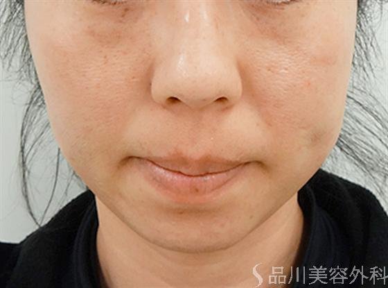 症例NO.13780のAFTER写真