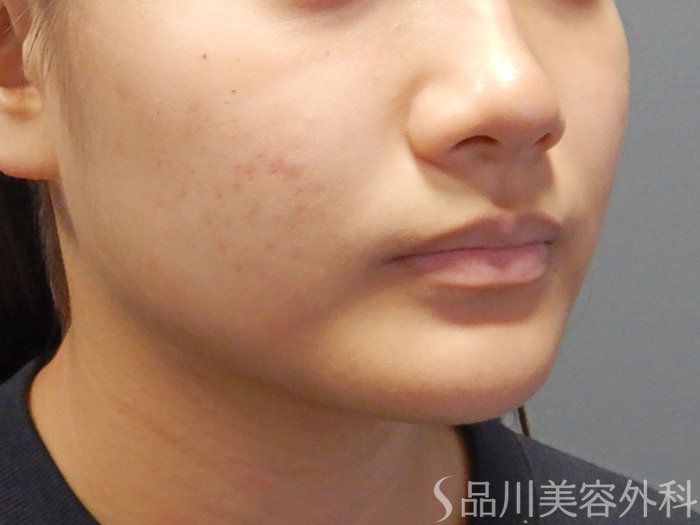 症例NO.72102のAFTER写真