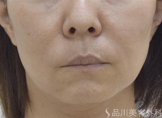 症例NO.53035のBEFORE写真