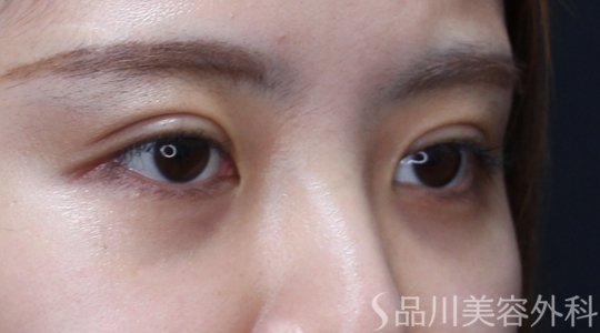 症例NO.71720のAFTER写真